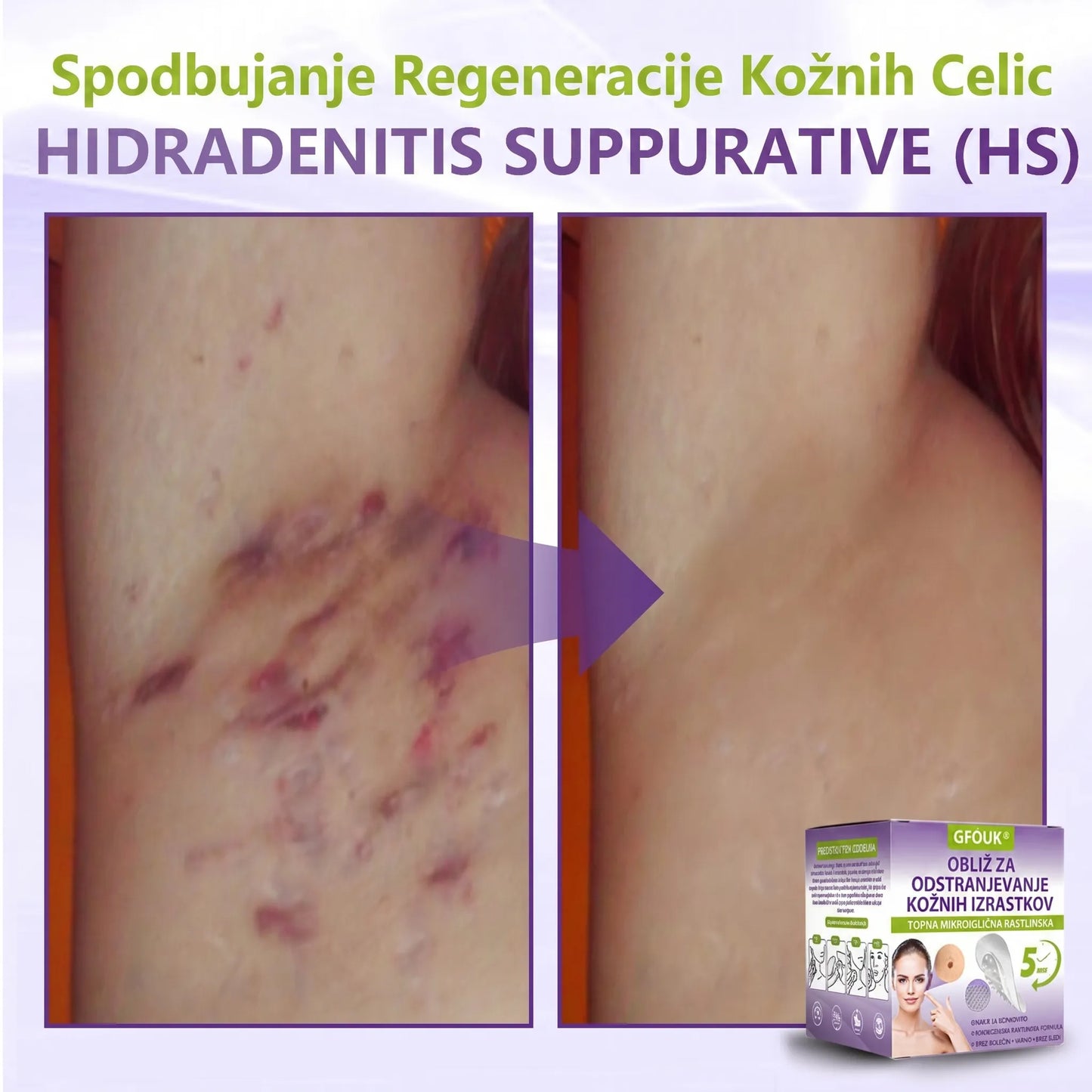 GFOUK® | 🇸🇮🧑‍⚕️Topni zeliščni obliž z mikroiglicami za odstranjevanje kožnih izrastkov in znamenj🌴🌴 — Odstrani nepravilnosti v samo 5 dneh, neboleče in brez brazgotin