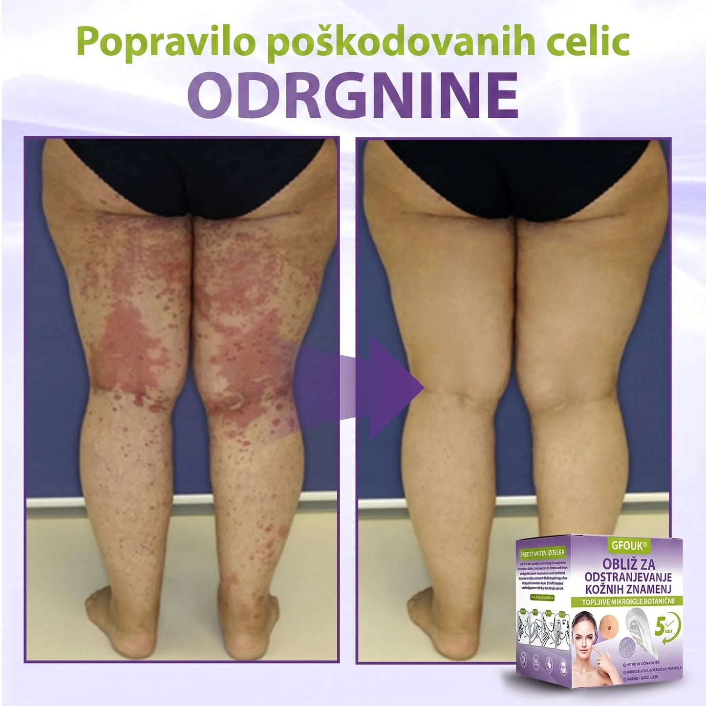 GFOUK® | 🇸🇮🧑‍⚕️Topni zeliščni obliž z mikroiglicami za odstranjevanje kožnih izrastkov in znamenj🌴🌴 — Odstrani nepravilnosti v samo 5 dneh, neboleče in brez brazgotin