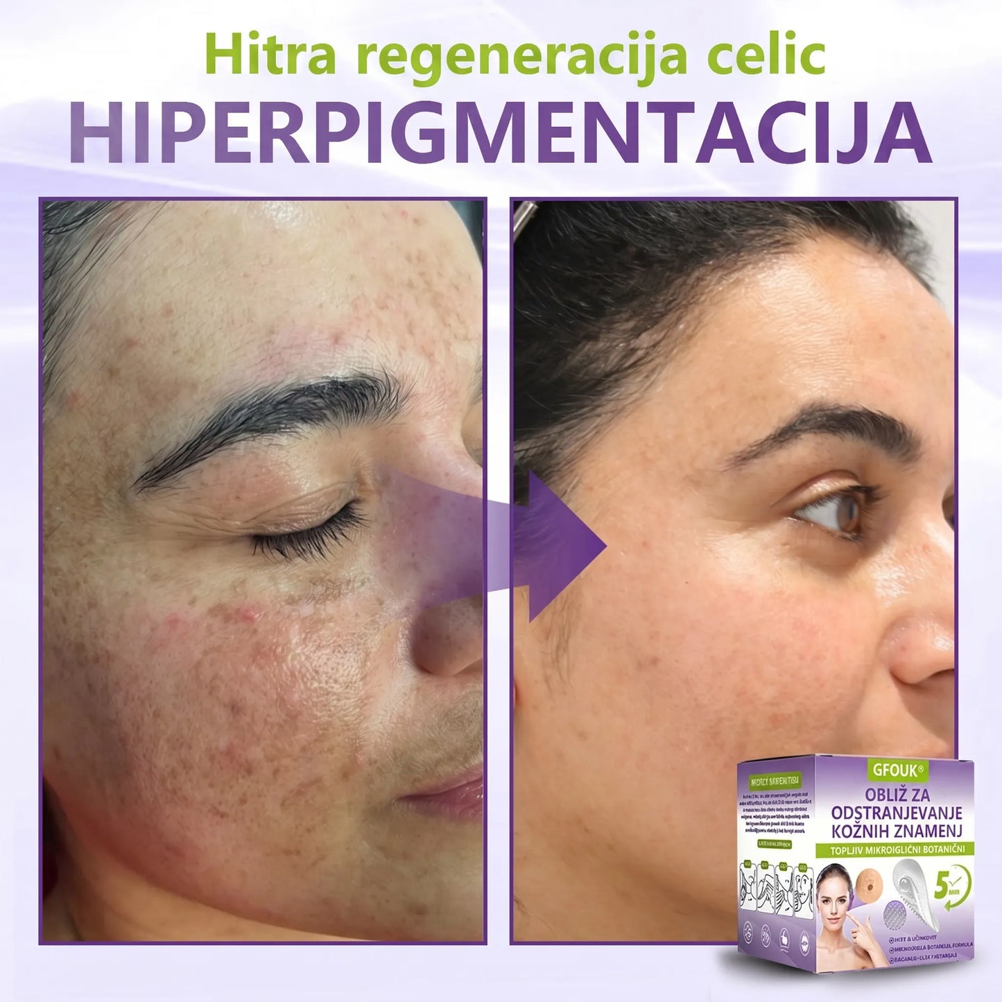 GFOUK® | 🇸🇮🧑‍⚕️Topni zeliščni obliž z mikroiglicami za odstranjevanje kožnih izrastkov in znamenj🌴🌴 — Odstrani nepravilnosti v samo 5 dneh, neboleče in brez brazgotin