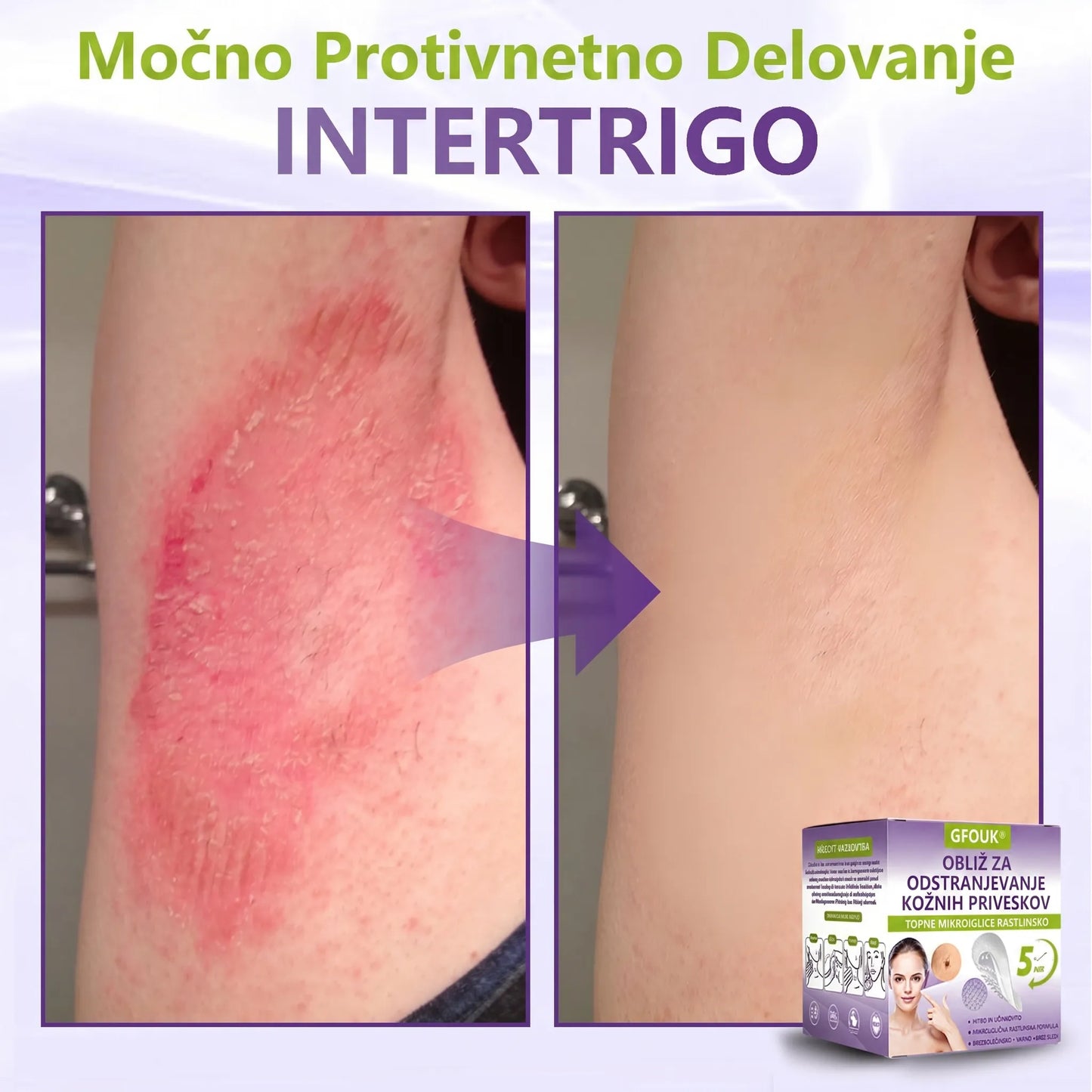 GFOUK® | 🇸🇮🧑‍⚕️Topni zeliščni obliž z mikroiglicami za odstranjevanje kožnih izrastkov in znamenj🌴🌴 — Odstrani nepravilnosti v samo 5 dneh, neboleče in brez brazgotin