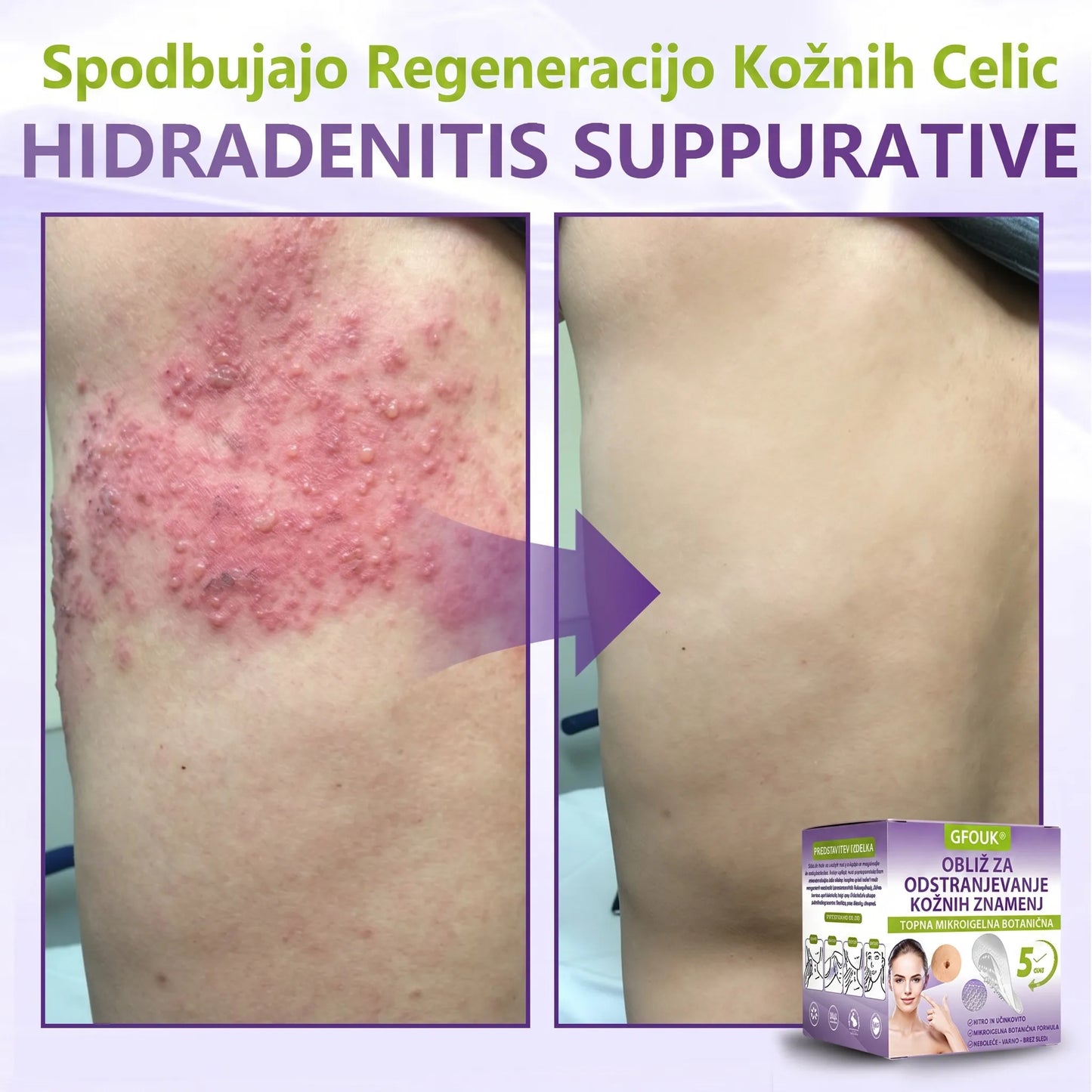 GFOUK® | 🇸🇮🧑‍⚕️Topni zeliščni obliž z mikroiglicami za odstranjevanje kožnih izrastkov in znamenj🌴🌴 — Odstrani nepravilnosti v samo 5 dneh, neboleče in brez brazgotin