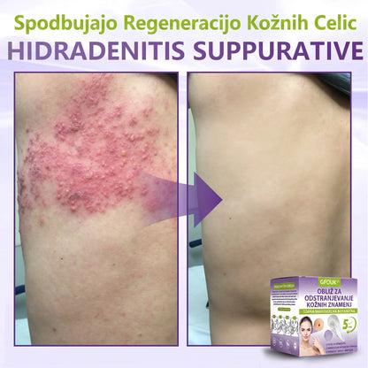 GFOUK® | 🇸🇮🧑‍⚕️Topni zeliščni obliž z mikroiglicami za odstranjevanje kožnih izrastkov in znamenj🌴🌴 — Odstrani nepravilnosti v samo 5 dneh, neboleče in brez brazgotin