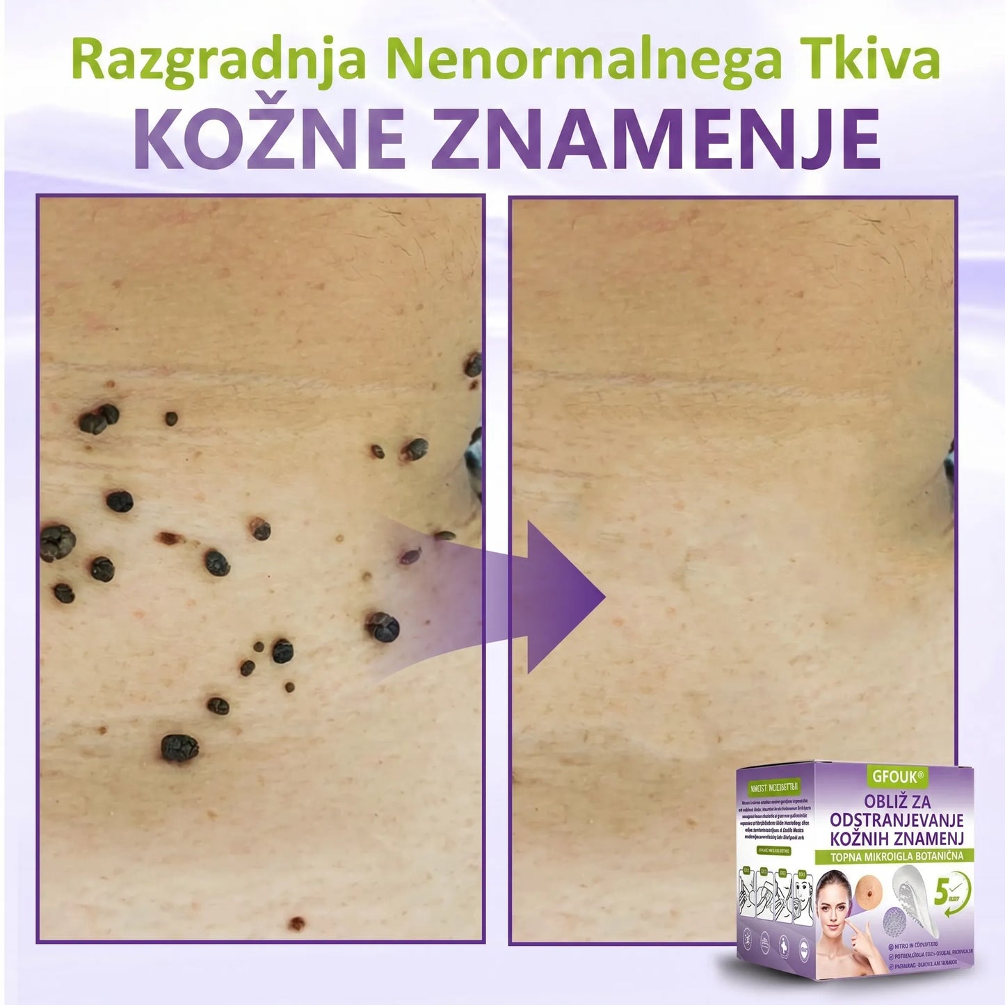 GFOUK® | 🇸🇮🧑‍⚕️Topni zeliščni obliž z mikroiglicami za odstranjevanje kožnih izrastkov in znamenj🌴🌴 — Odstrani nepravilnosti v samo 5 dneh, neboleče in brez brazgotin