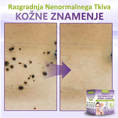 GFOUK® | 🇸🇮🧑‍⚕️Topni zeliščni obliž z mikroiglicami za odstranjevanje kožnih izrastkov in znamenj🌴🌴 — Odstrani nepravilnosti v samo 5 dneh, neboleče in brez brazgotin