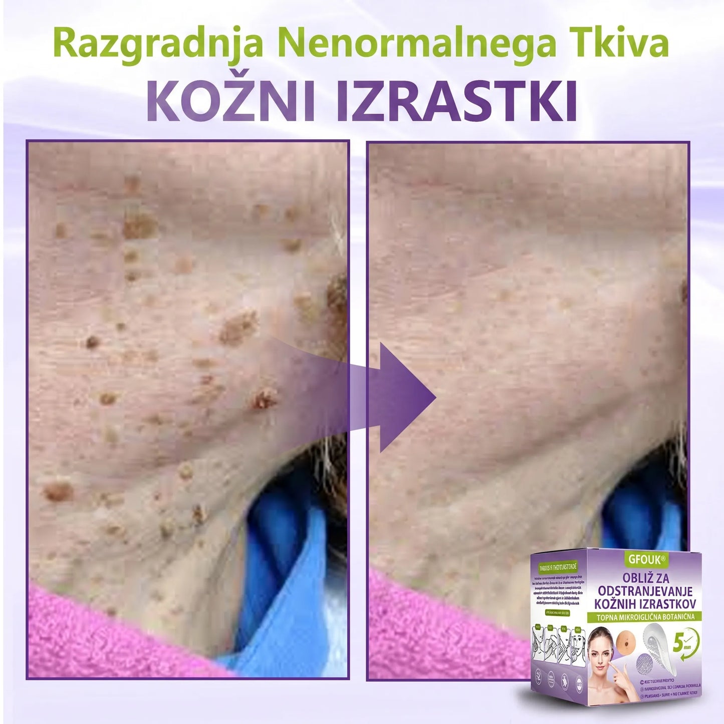 GFOUK® | 🇸🇮🧑‍⚕️Topni zeliščni obliž z mikroiglicami za odstranjevanje kožnih izrastkov in znamenj🌴🌴 — Odstrani nepravilnosti v samo 5 dneh, neboleče in brez brazgotin