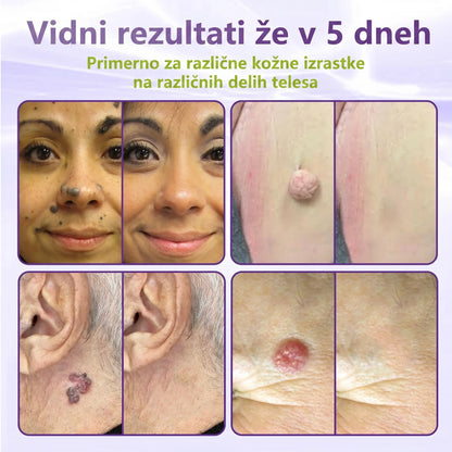 GFOUK® | 🇸🇮🧑‍⚕️Topni zeliščni obliž z mikroiglicami za odstranjevanje kožnih izrastkov in znamenj🌴🌴 — Odstrani nepravilnosti v samo 5 dneh, neboleče in brez brazgotin